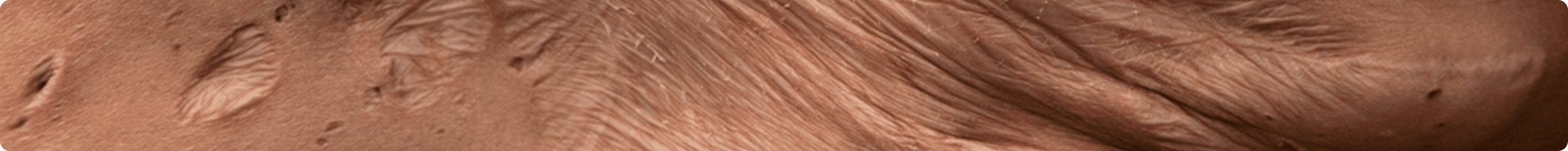Close-up of skin with Hidradenitis suppurativa