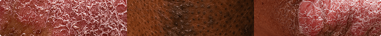 Three side-by-side close-ups of skin texture. One close-up of skin with Hidradenitis suppurativa. One close-up of skin with PSO. One close-up of skin with PsA