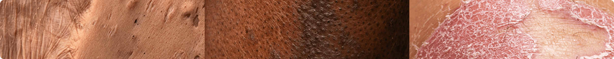 Three side-by-side close-ups of skin texture. One close-up of skin with Hidradenitis suppurativa. One close-up of skin with PSO. One close-up of skin with PsA